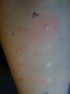 Compare 2nd allergy test, left side has no reaction to cat hair!